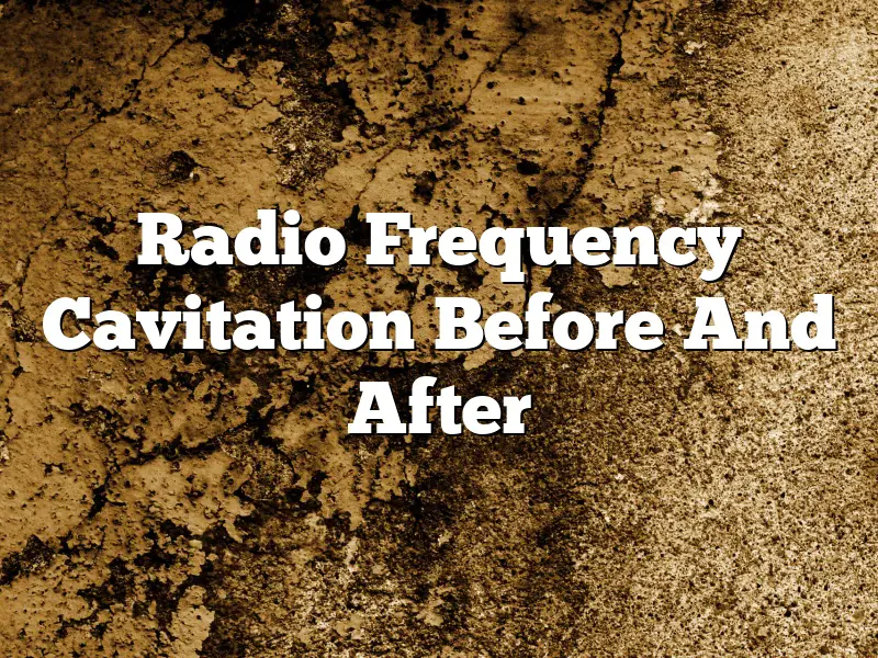 Radio Frequency Cavitation Before And After
