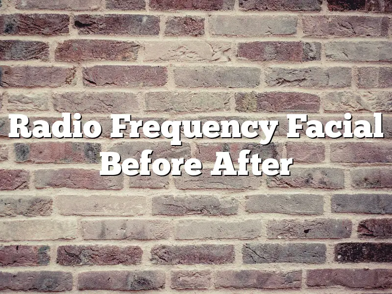 Radio Frequency Facial Before After