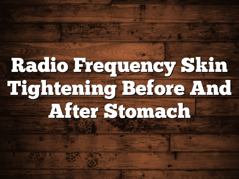 Radio Frequency Skin Tightening Before And After Stomach