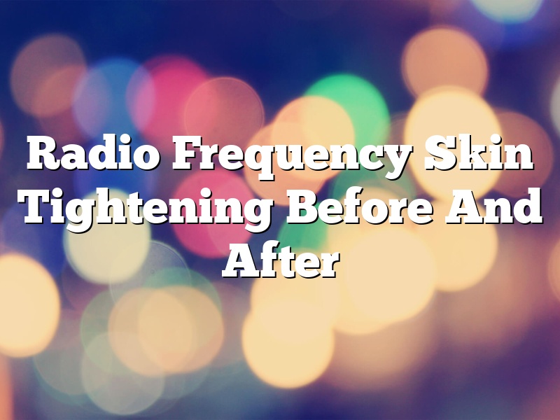 Radio Frequency Skin Tightening Before And After